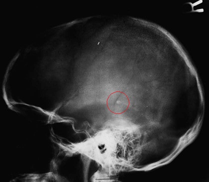 Cái nhìn khoa học về tuyến tùng (pineal gland) Pineal Gland of a 44-year-old Man